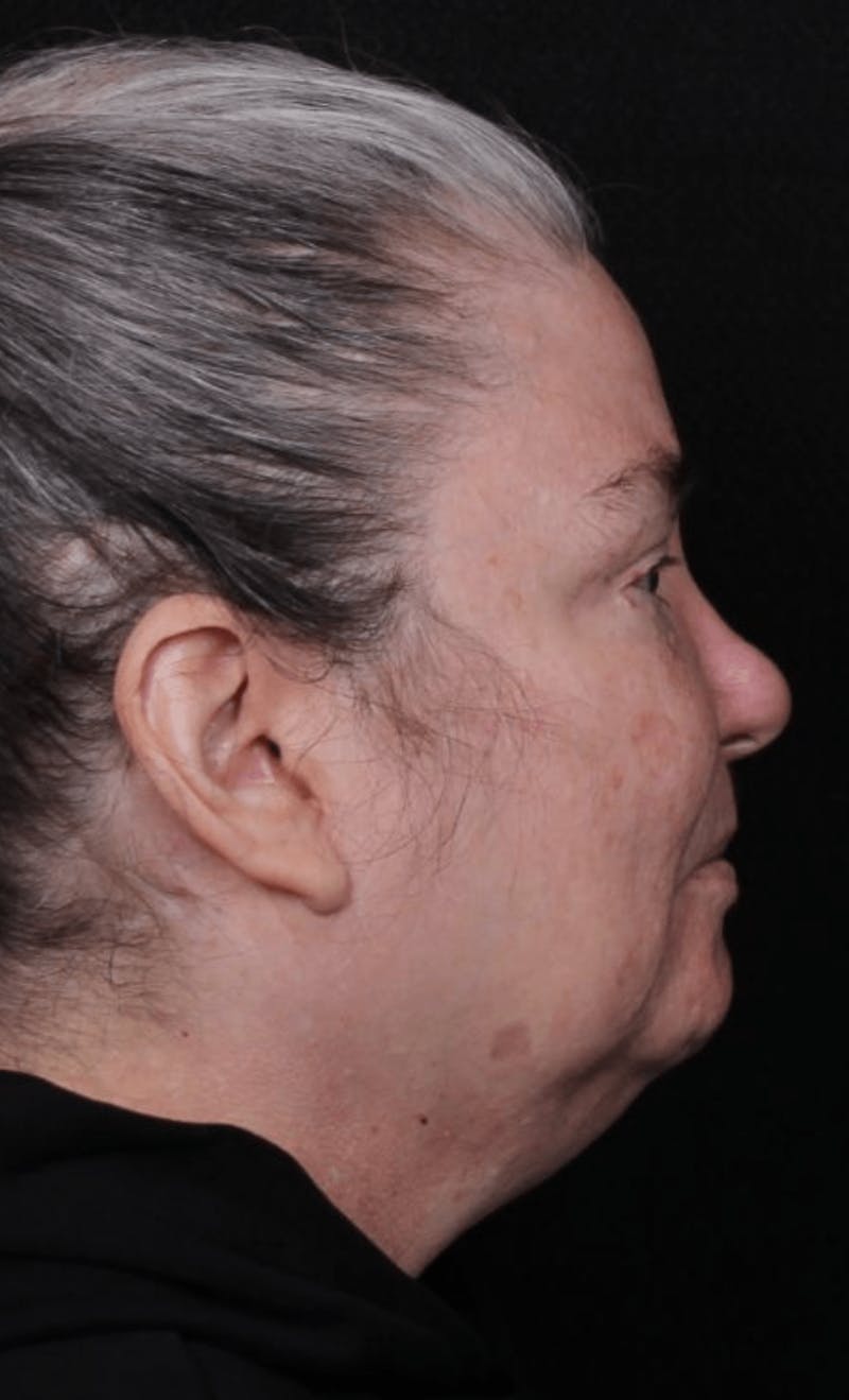 Face & Neck Lift Before & After Gallery - Patient 262727 - Image 3