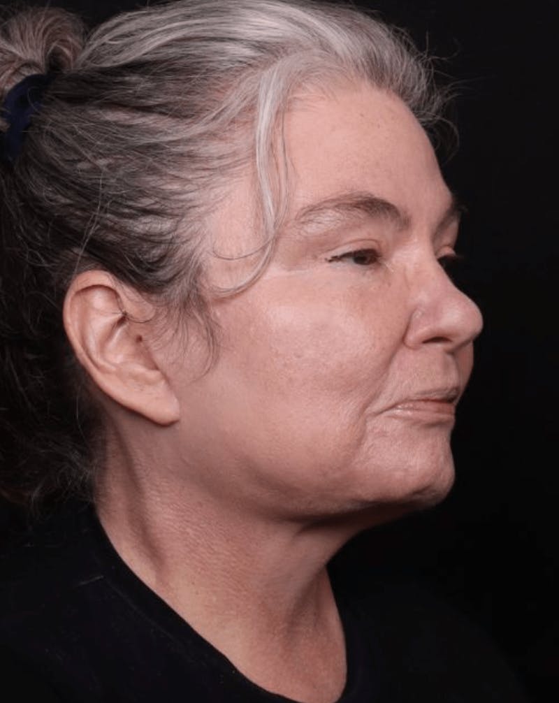Face & Neck Lift Before & After Gallery - Patient 262727 - Image 6