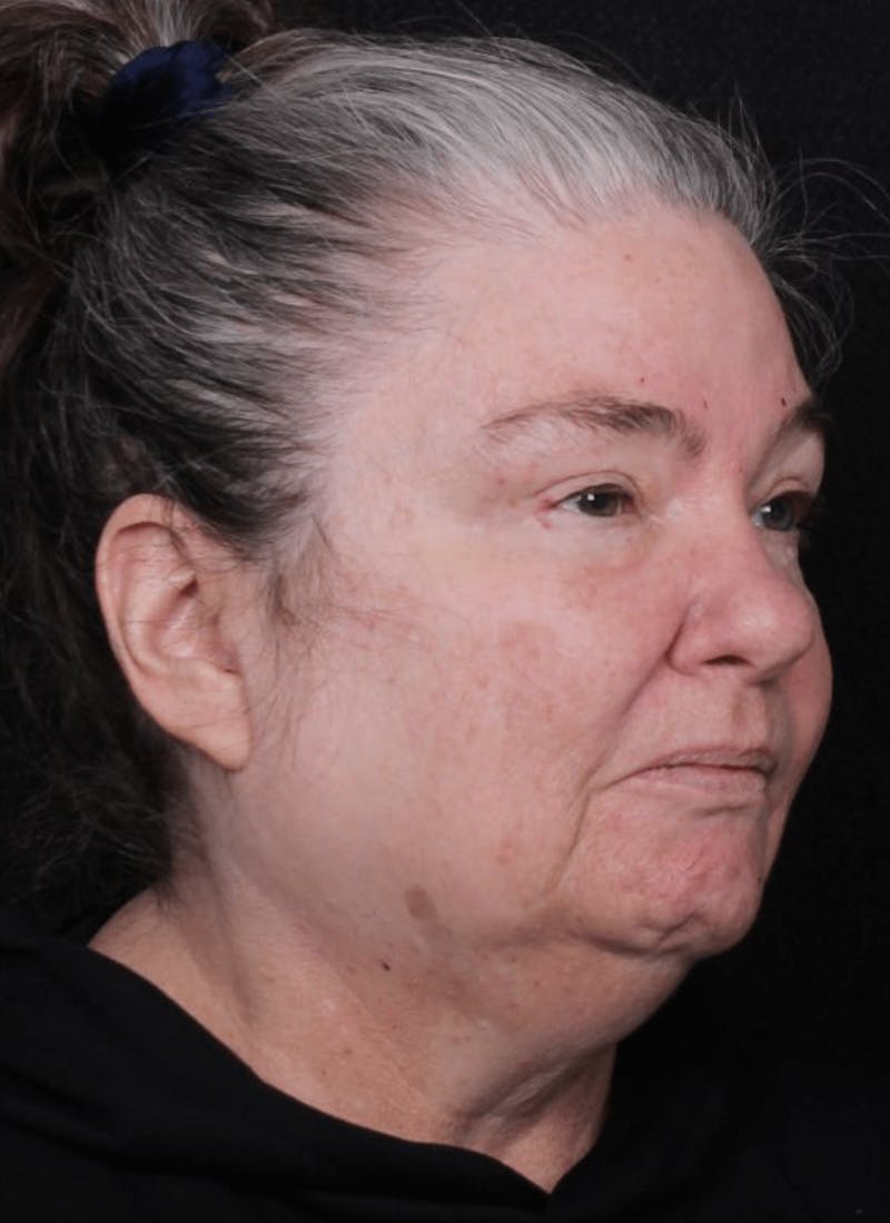 Face & Neck Lift Before & After Gallery - Patient 262727 - Image 5