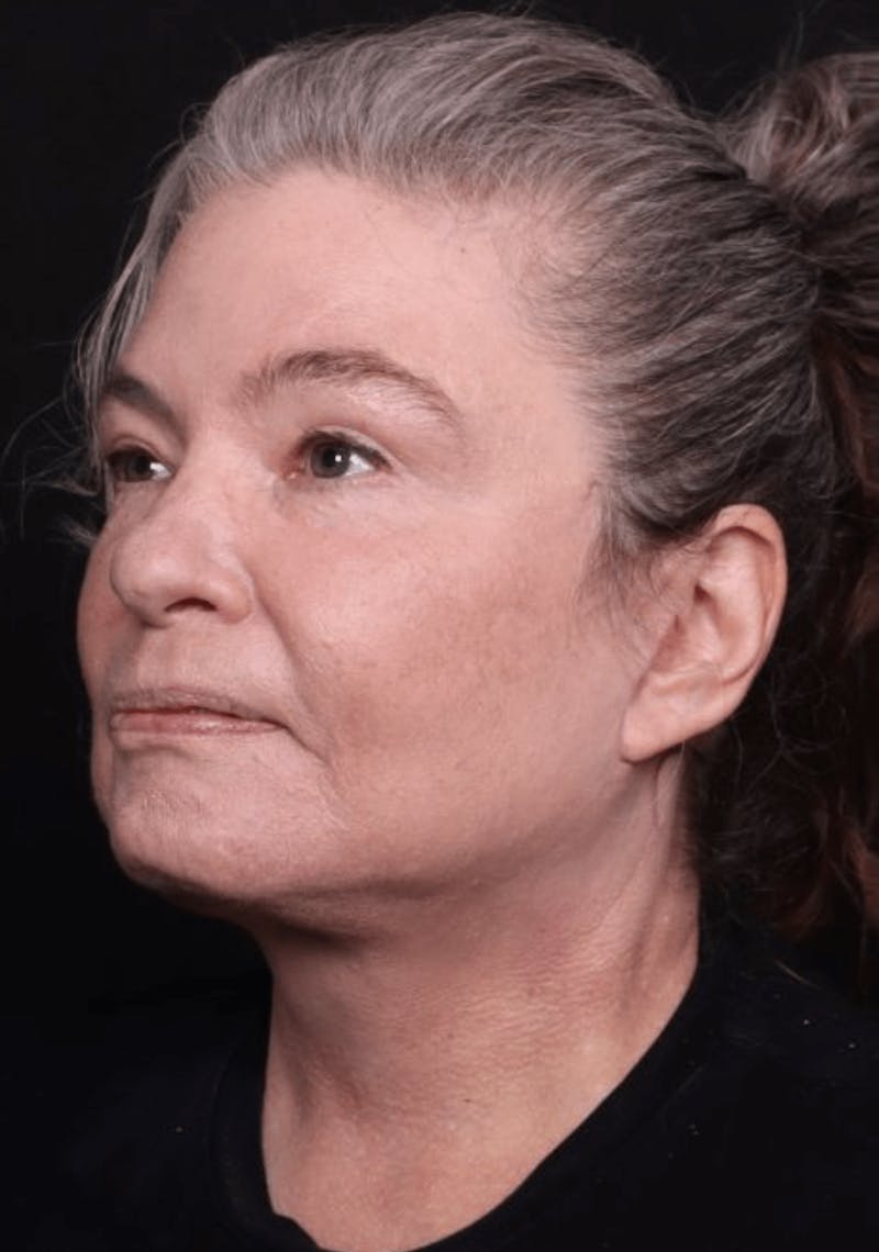 Face & Neck Lift Before & After Gallery - Patient 262727 - Image 8