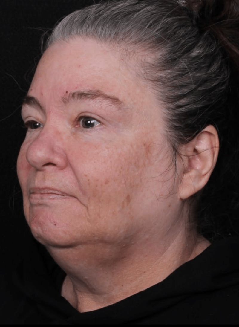 Face & Neck Lift Before & After Gallery - Patient 262727 - Image 7