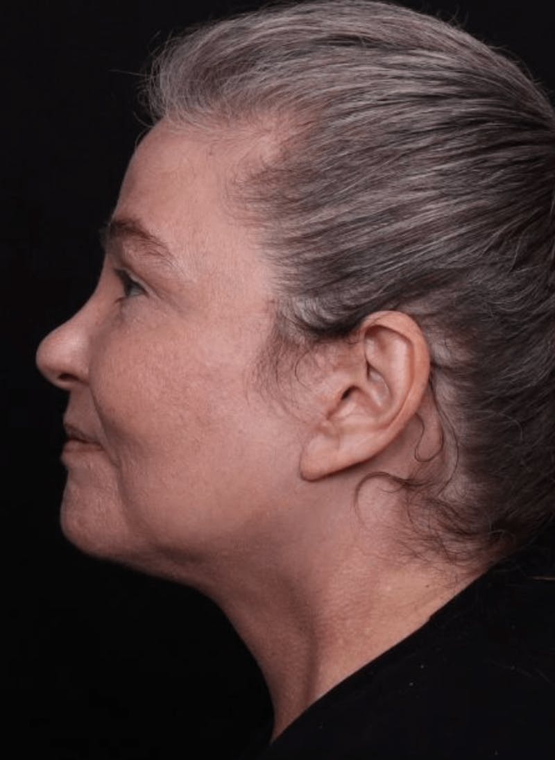 Face & Neck Lift Before & After Gallery - Patient 262727 - Image 10