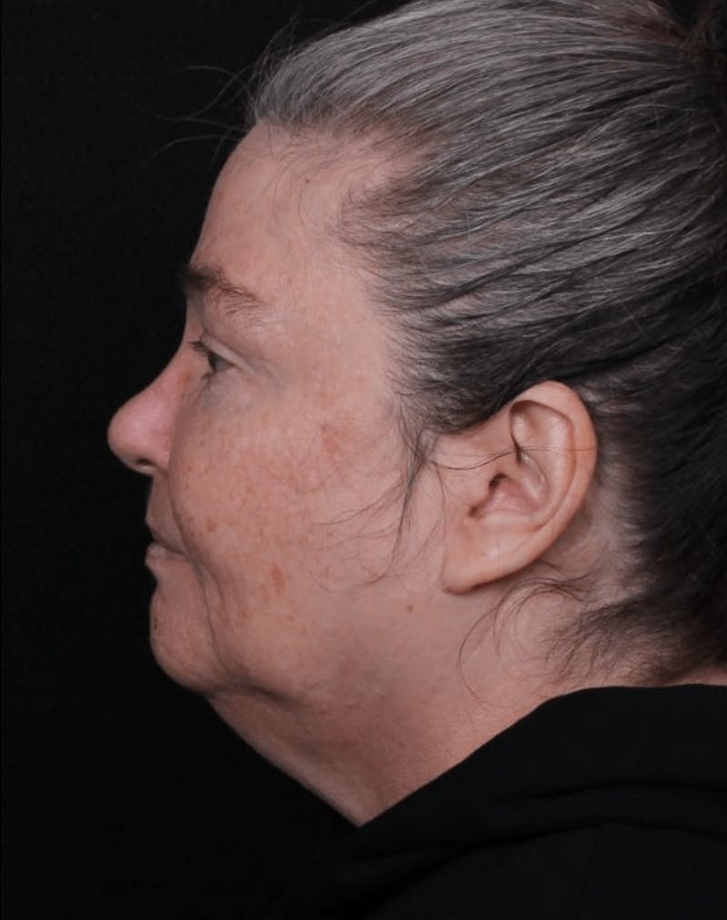 Face & Neck Lift Before & After Gallery - Patient 262727 - Image 9