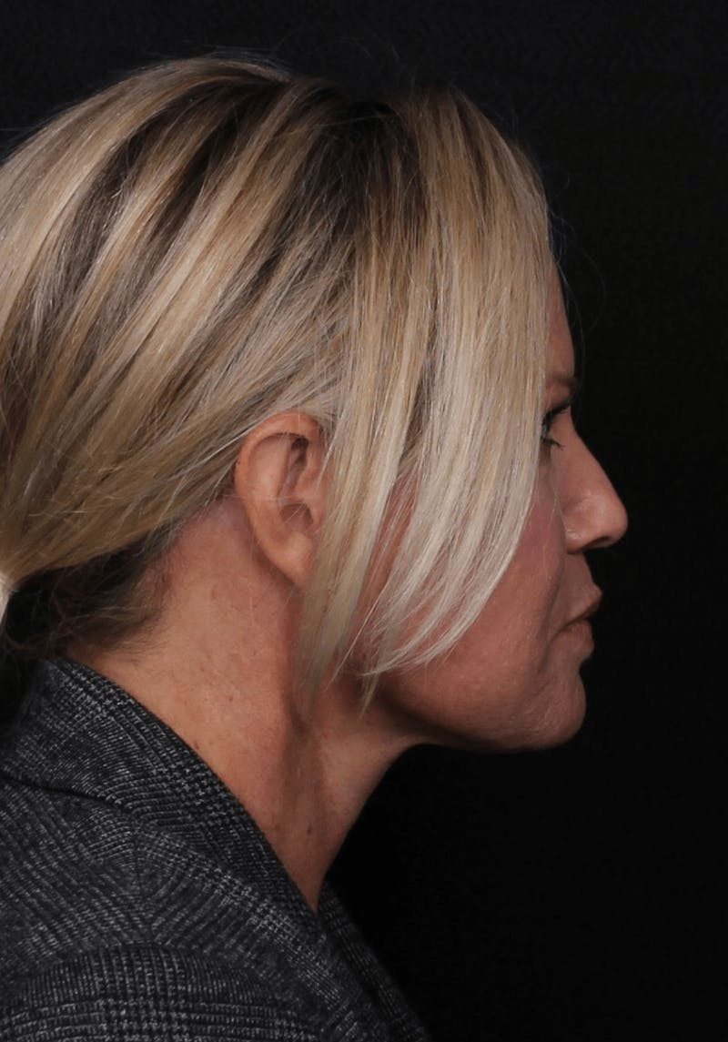 Face & Neck Lift Before & After Gallery - Patient 107486 - Image 4
