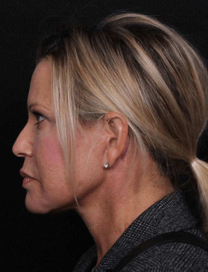 Face & Neck Lift Before & After Gallery - Patient 107486 - Image 8