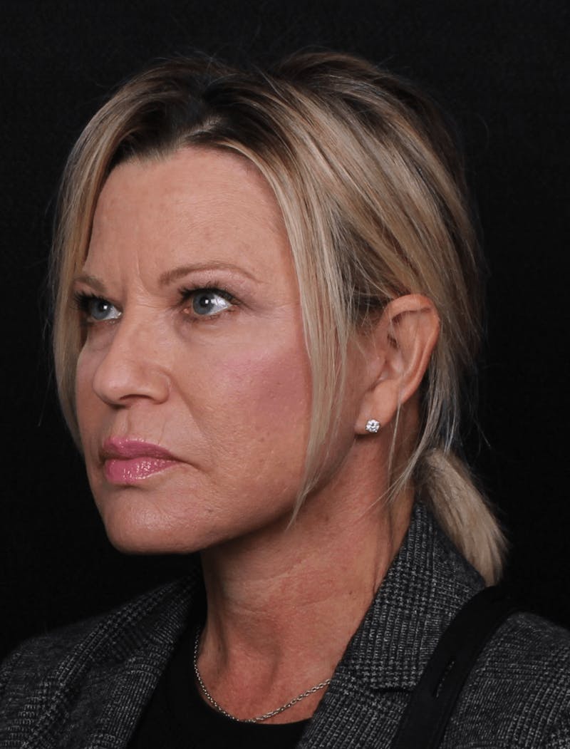 Face & Neck Lift Before & After Gallery - Patient 107486 - Image 10