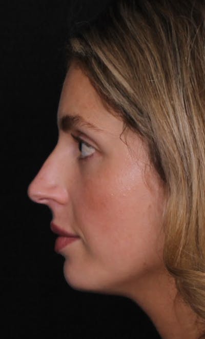Rhinoplasty Female Before & After Gallery - Patient 350474 - Image 1