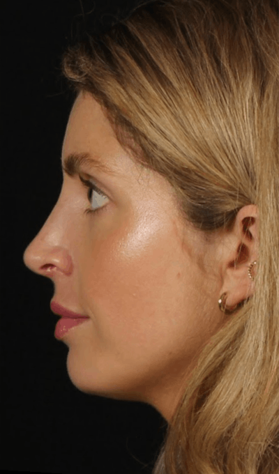 Rhinoplasty Female Before & After Gallery - Patient 350474 - Image 2