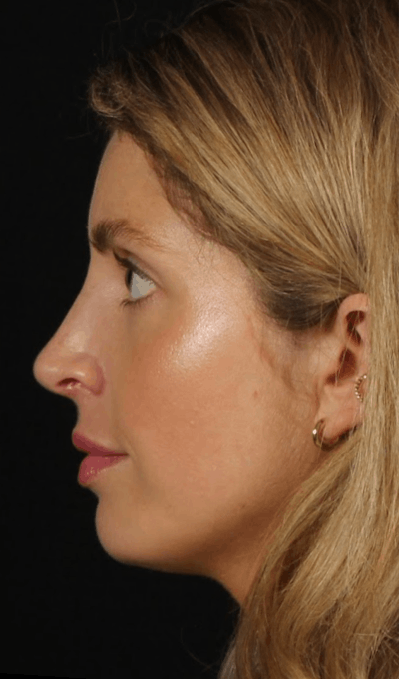 Rhinoplasty Female Before & After Gallery - Patient 350474 - Image 2