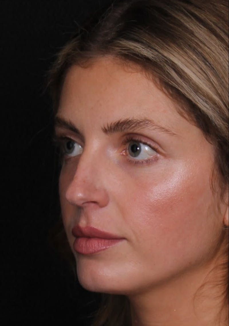 Rhinoplasty Female Before & After Gallery - Patient 350474 - Image 3