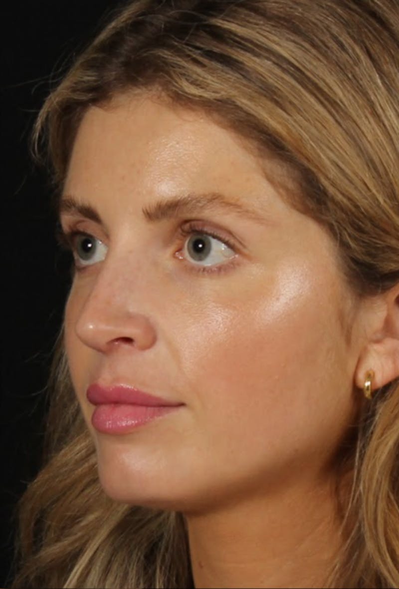 Rhinoplasty Female Before & After Gallery - Patient 350474 - Image 4