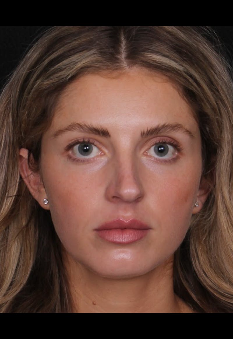 Rhinoplasty Female Before & After Gallery - Patient 350474 - Image 5