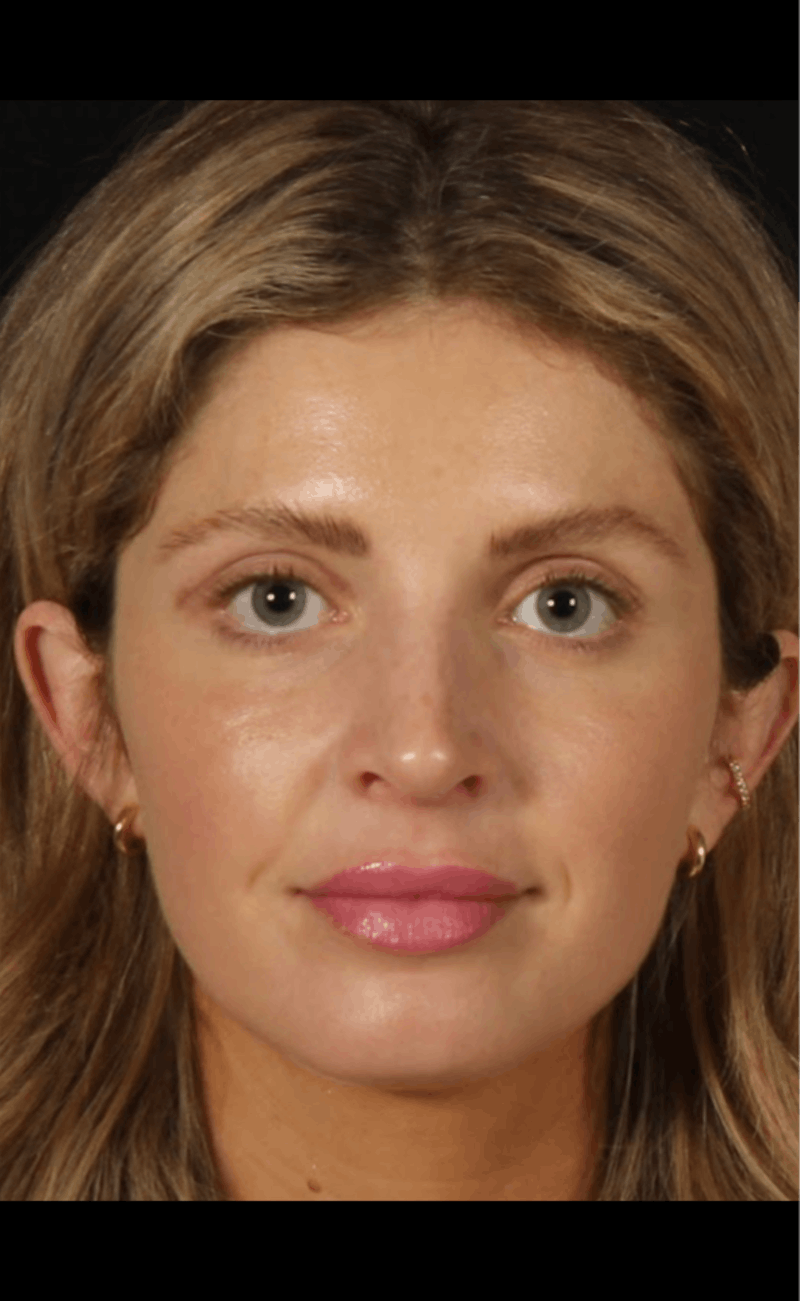Rhinoplasty Female Before & After Gallery - Patient 350474 - Image 6