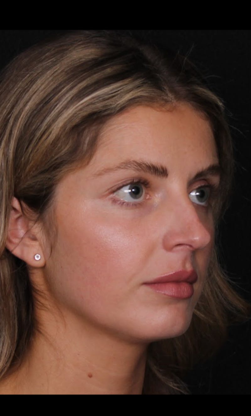 Rhinoplasty Female Before & After Gallery - Patient 350474 - Image 7