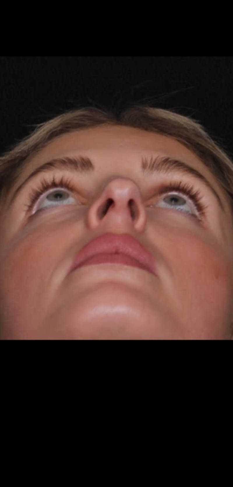 Rhinoplasty Female Before & After Gallery - Patient 350474 - Image 9