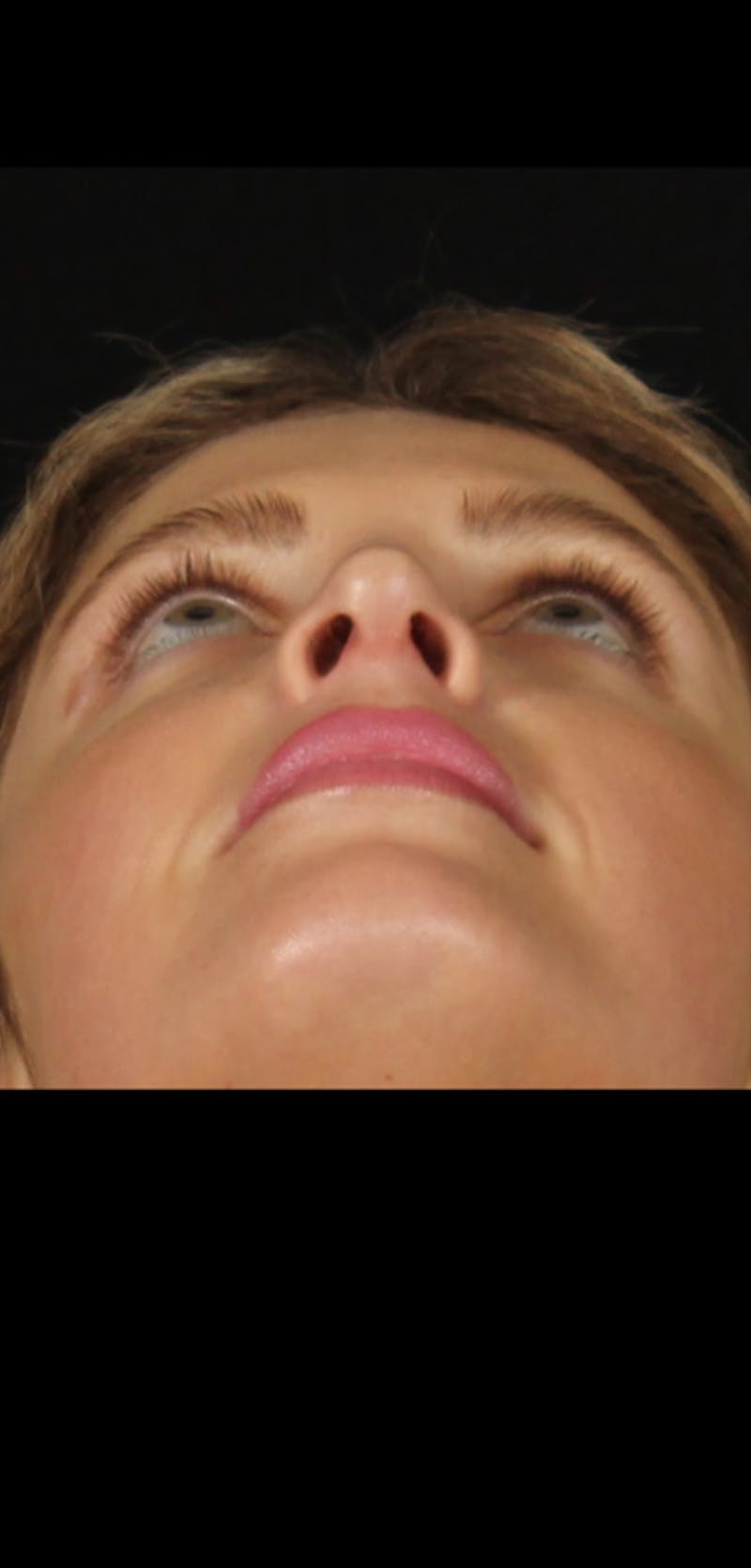 Rhinoplasty Female Before & After Gallery - Patient 350474 - Image 10