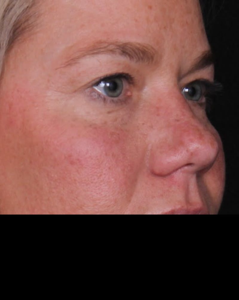 Blepharoplasty Before & After Gallery - Patient 428621 - Image 1