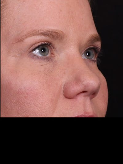 Blepharoplasty Before & After Gallery - Patient 428621 - Image 2