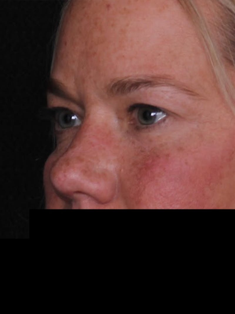 Blepharoplasty Before & After Gallery - Patient 428621 - Image 3