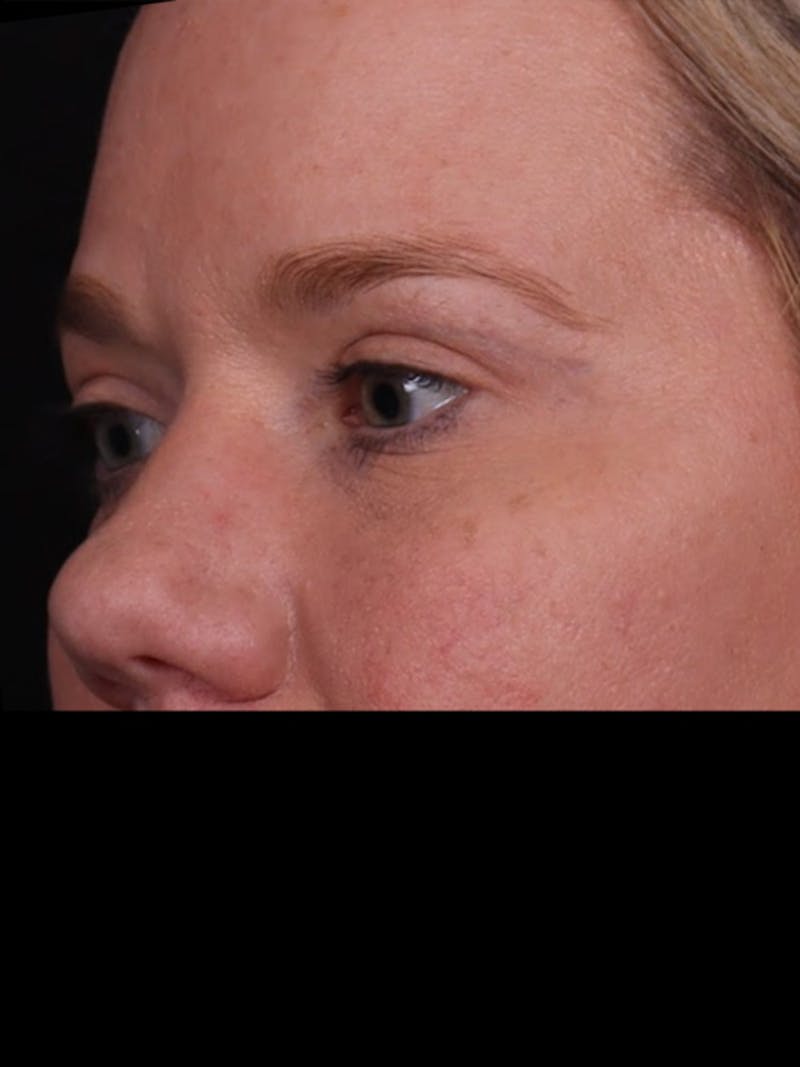 Blepharoplasty Before & After Gallery - Patient 428621 - Image 4