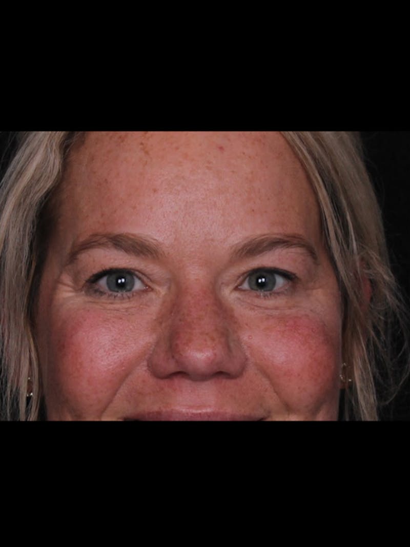 Blepharoplasty Before & After Gallery - Patient 428621 - Image 5