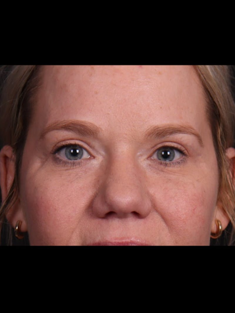 Blepharoplasty Before & After Gallery - Patient 428621 - Image 6