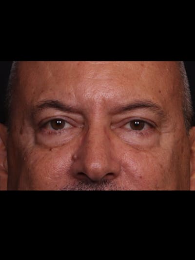 Blepharoplasty Before & After Gallery - Patient 369878 - Image 1