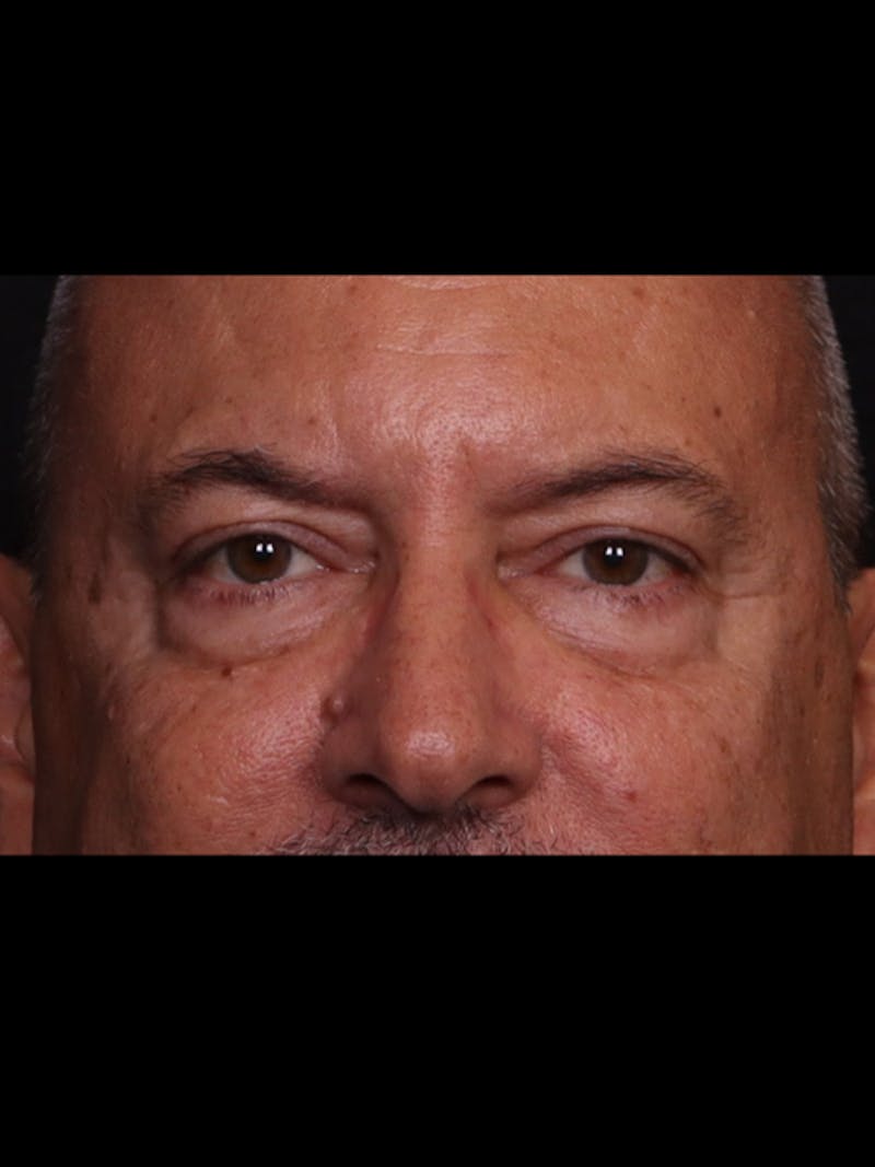 Blepharoplasty Before & After Gallery - Patient 369878 - Image 1