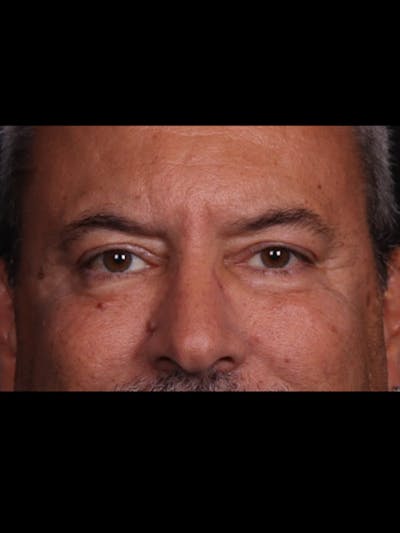 Blepharoplasty Before & After Gallery - Patient 369878 - Image 2