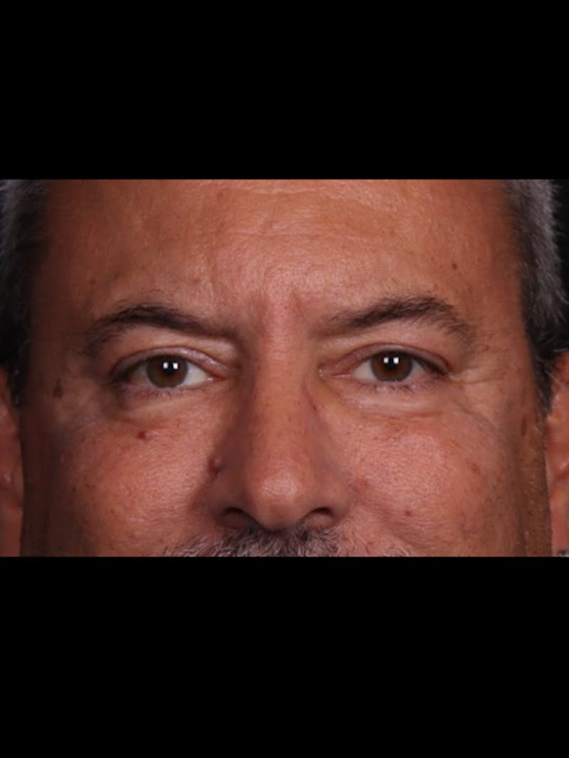 Blepharoplasty Before & After Gallery - Patient 369878 - Image 2