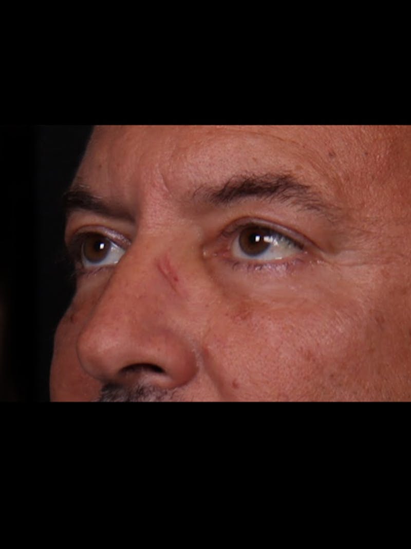 Blepharoplasty Before & After Gallery - Patient 369878 - Image 4