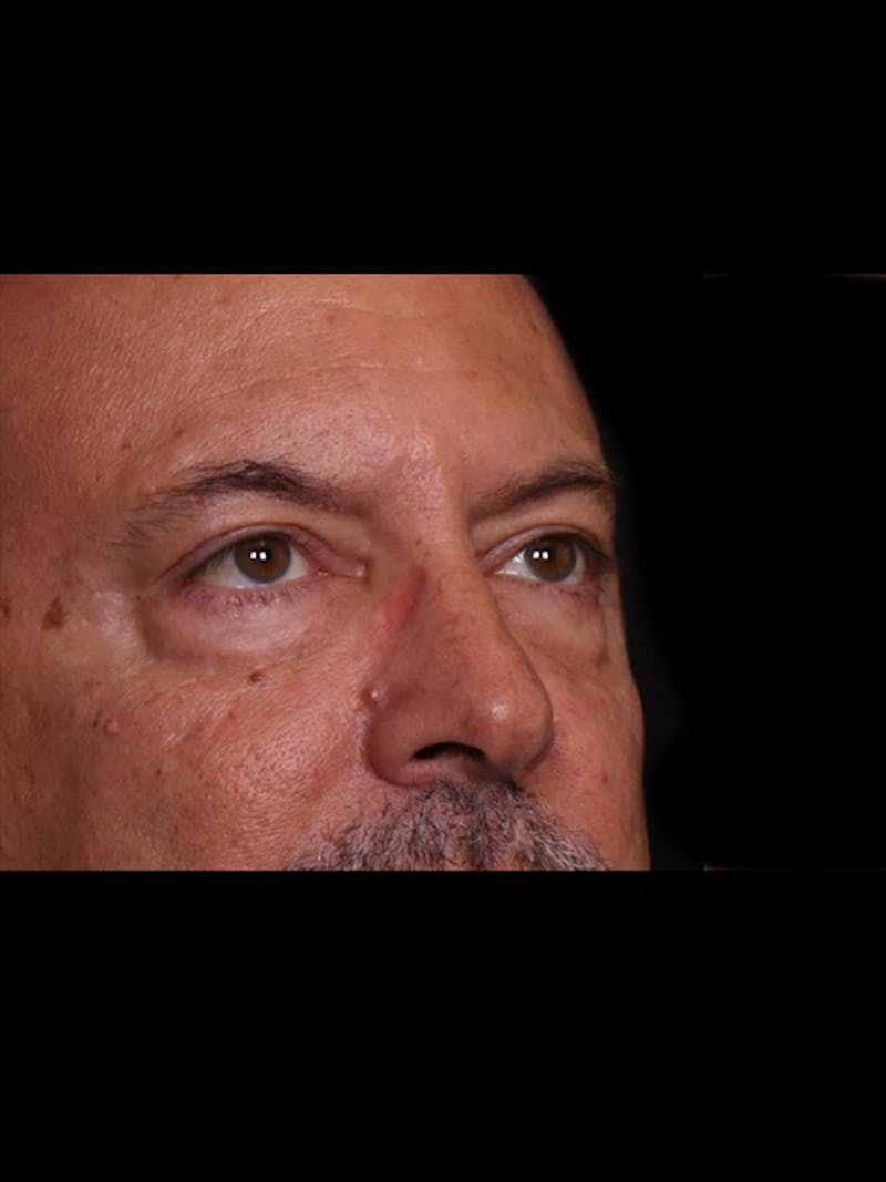 Blepharoplasty Before & After Gallery - Patient 369878 - Image 5