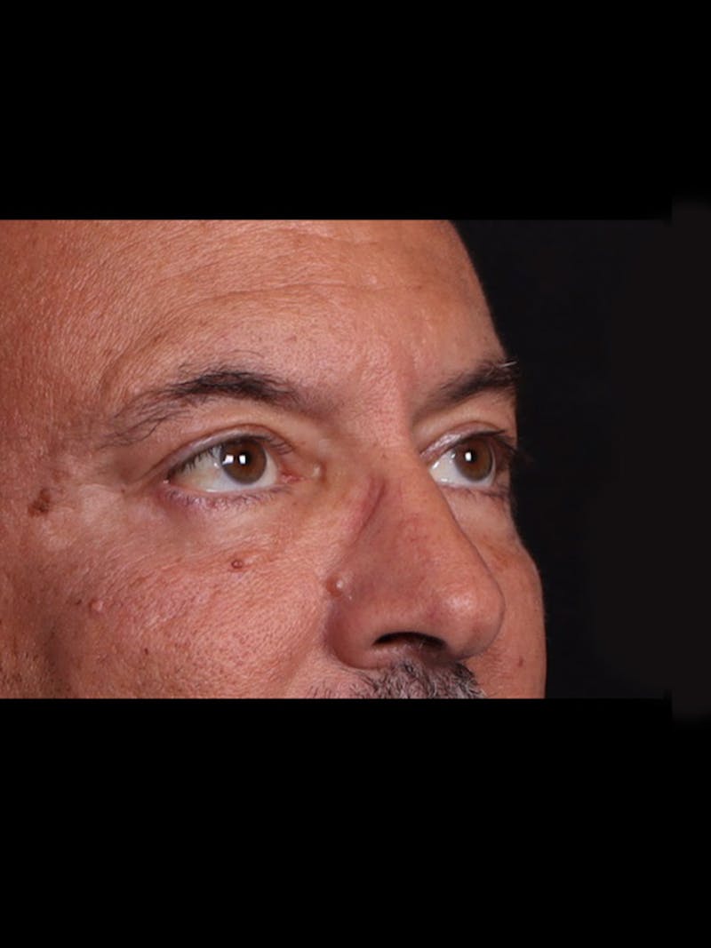 Blepharoplasty Before & After Gallery - Patient 369878 - Image 6