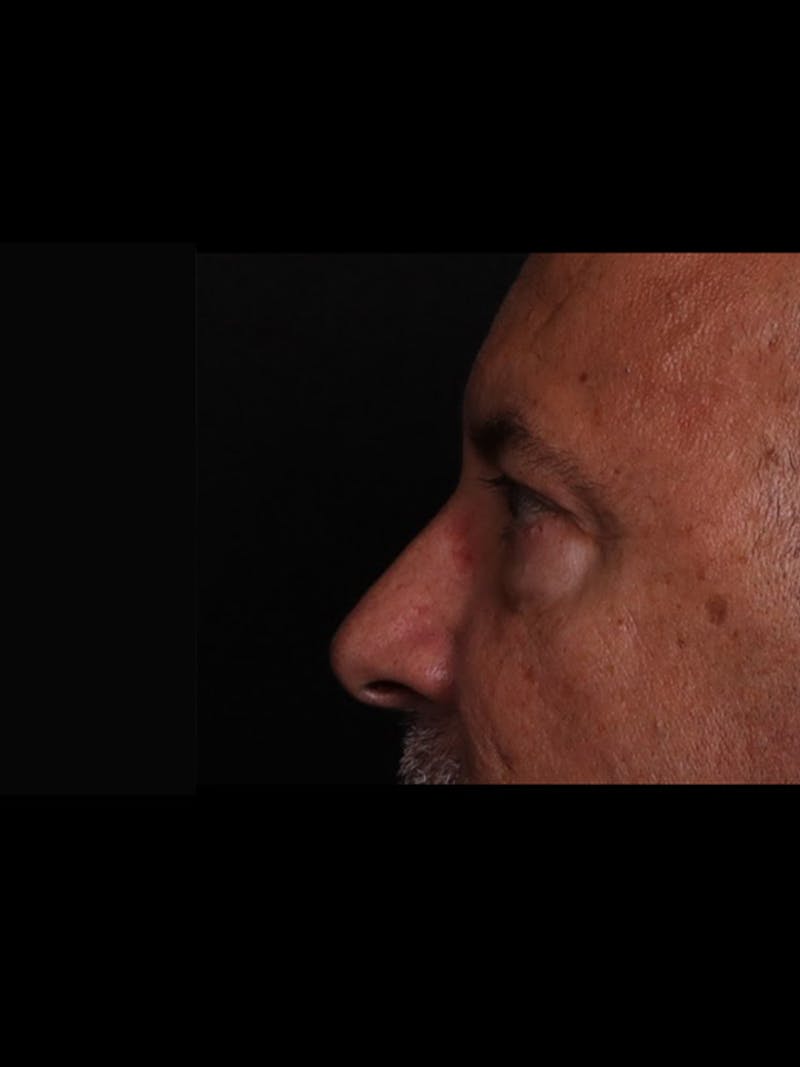 Blepharoplasty Before & After Gallery - Patient 369878 - Image 7