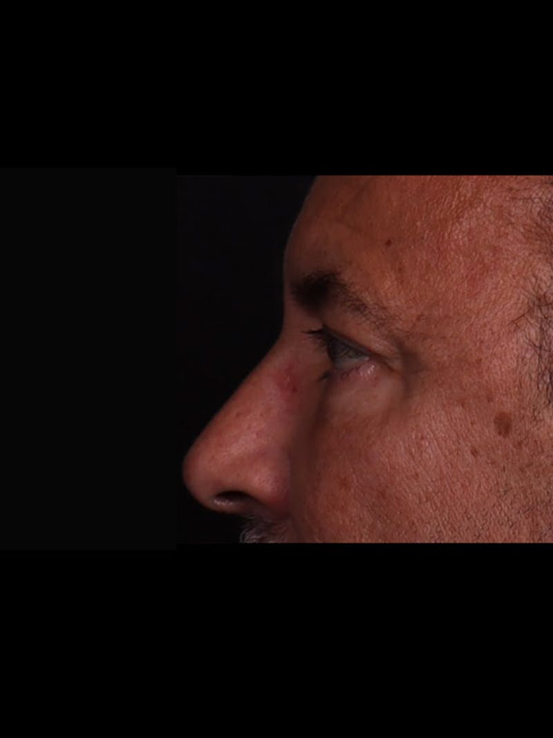 Blepharoplasty Before & After Gallery - Patient 369878 - Image 8