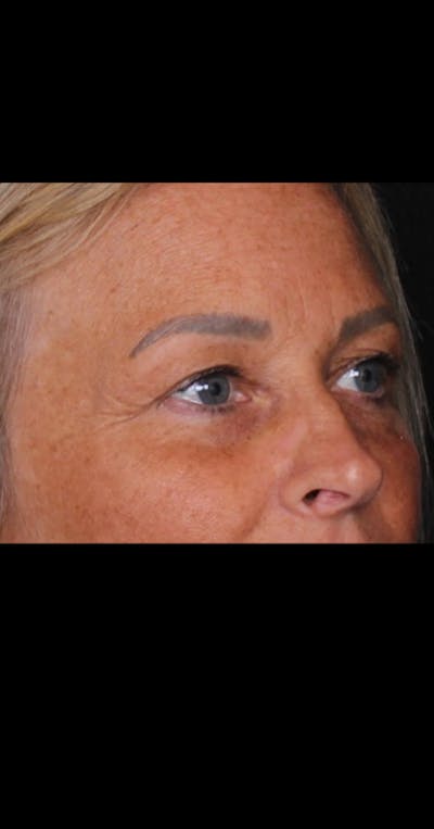 Blepharoplasty Before & After Gallery - Patient 290426 - Image 1