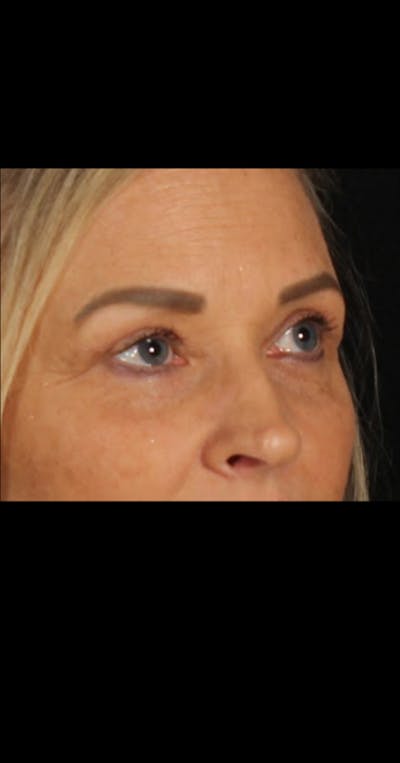 Blepharoplasty Before & After Gallery - Patient 290426 - Image 2