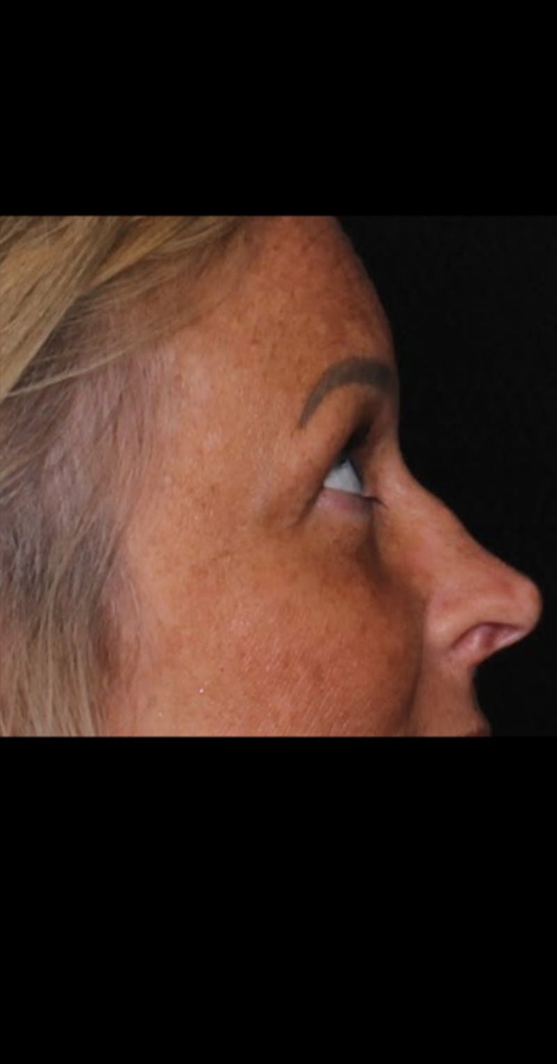 Blepharoplasty Before & After Gallery - Patient 290426 - Image 3