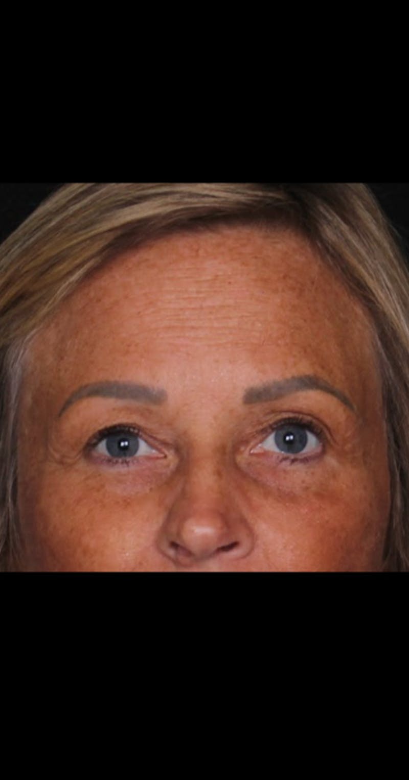 Blepharoplasty Before & After Gallery - Patient 290426 - Image 5