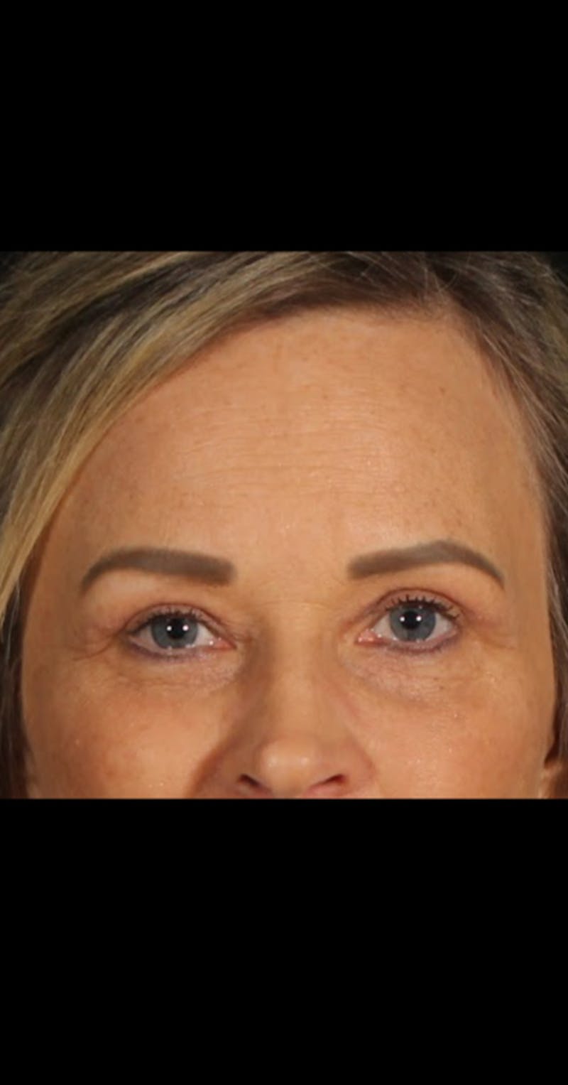 Blepharoplasty Before & After Gallery - Patient 290426 - Image 6