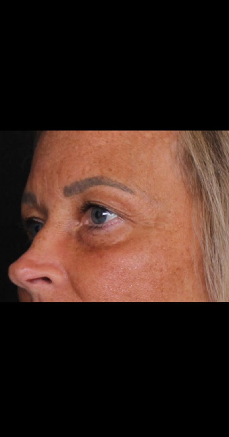 Blepharoplasty Before & After Gallery - Patient 290426 - Image 7