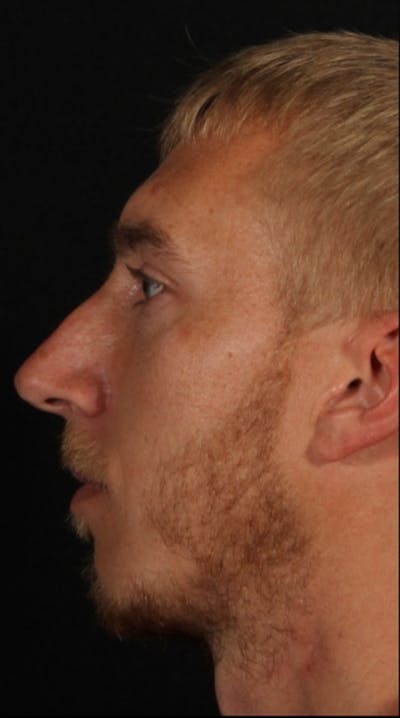 Rhinoplasty Male Before & After Gallery - Patient 418142 - Image 1
