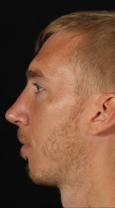 Rhinoplasty Male Before & After Gallery - Patient 418142 - Image 2