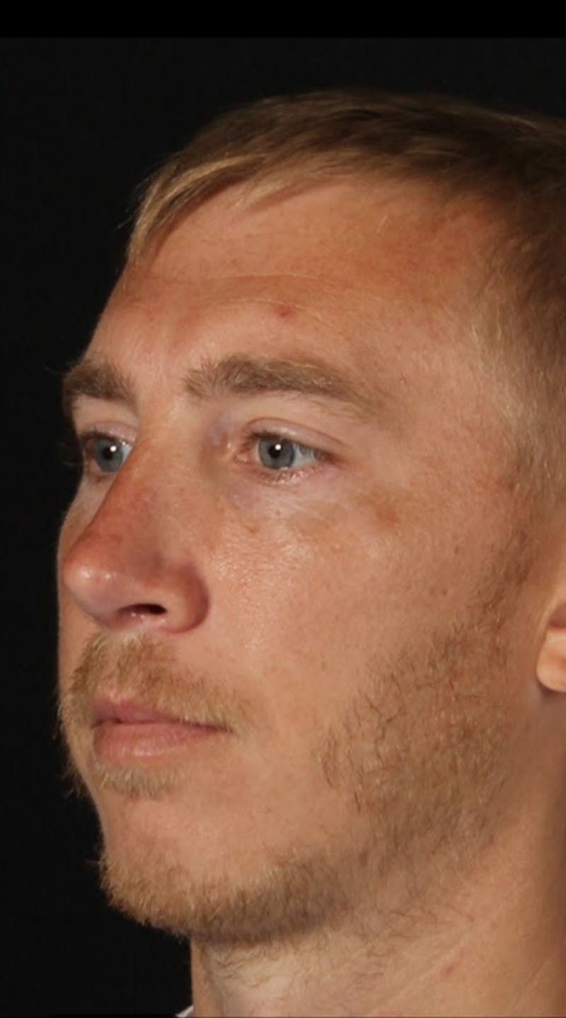 Rhinoplasty Male Before & After Gallery - Patient 418142 - Image 3