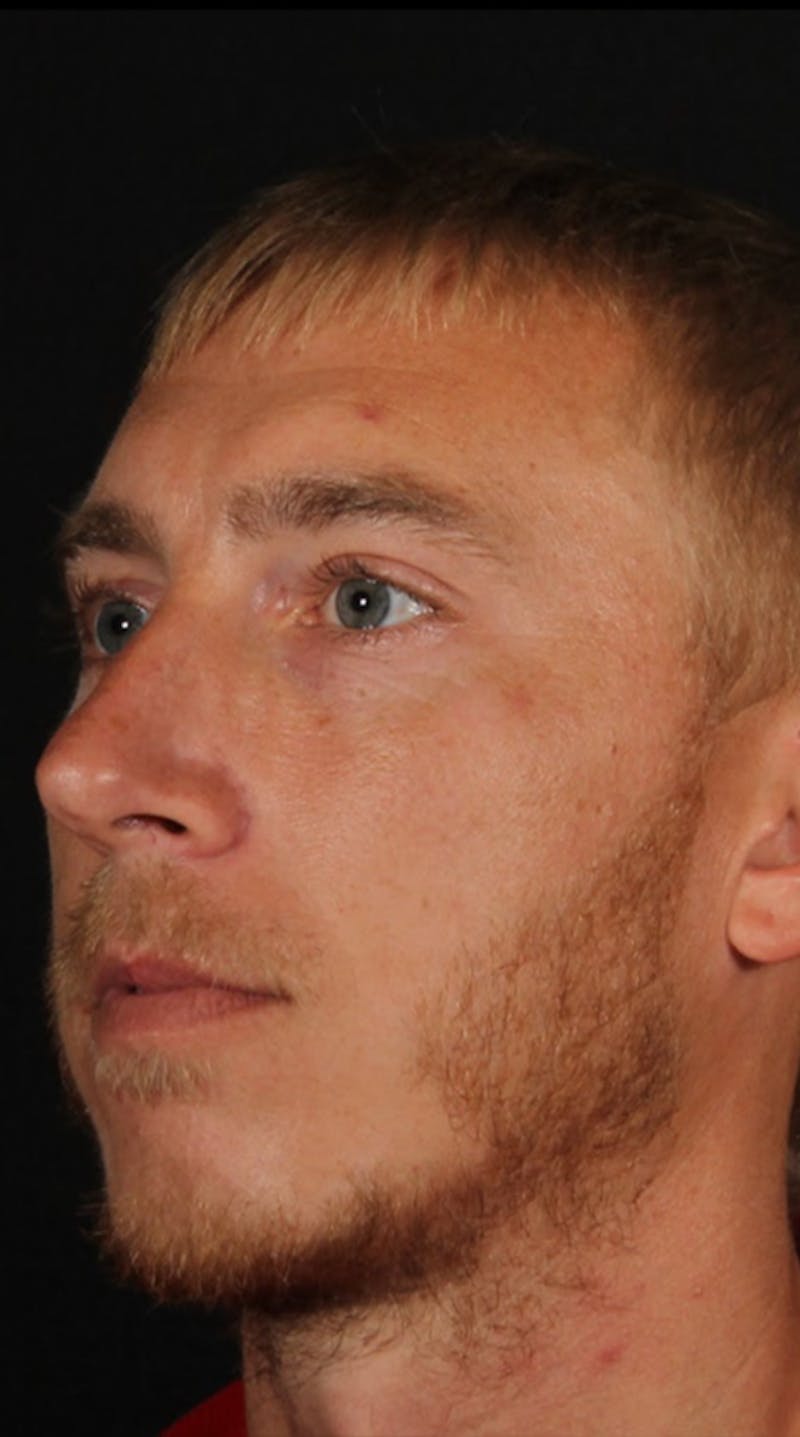 Rhinoplasty Male Before & After Gallery - Patient 418142 - Image 4
