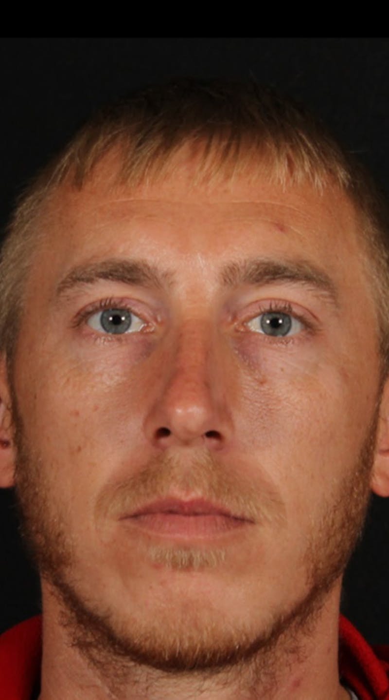 Rhinoplasty Male Before & After Gallery - Patient 418142 - Image 5