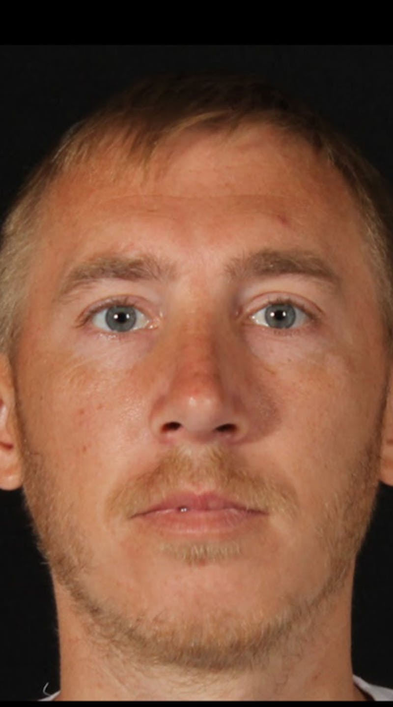 Rhinoplasty Male Before & After Gallery - Patient 418142 - Image 6