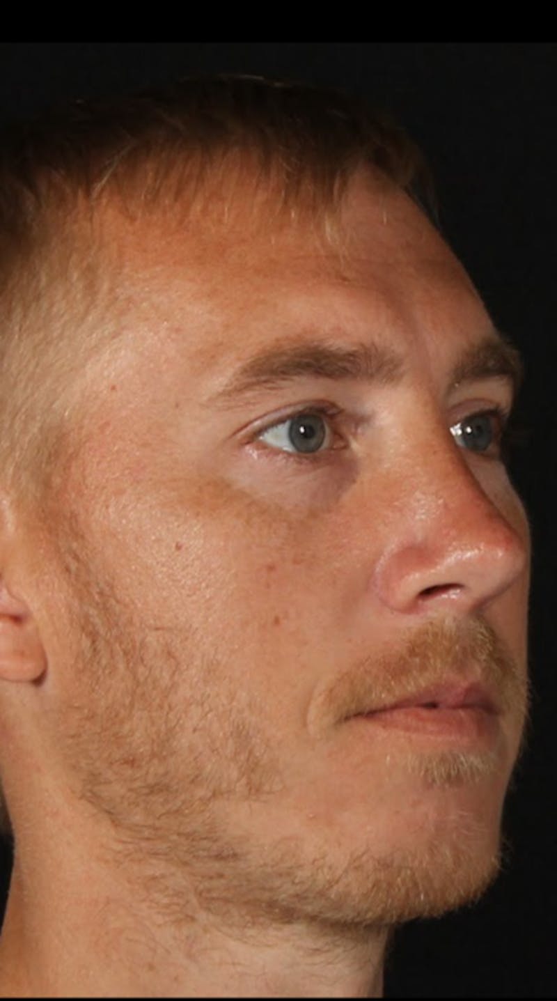 Rhinoplasty Male Before & After Gallery - Patient 418142 - Image 8