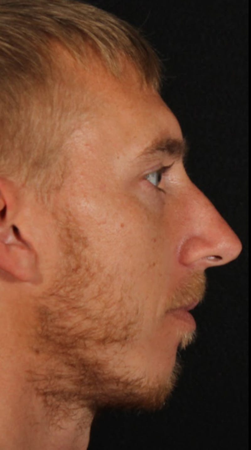 Rhinoplasty Male Before & After Gallery - Patient 418142 - Image 9