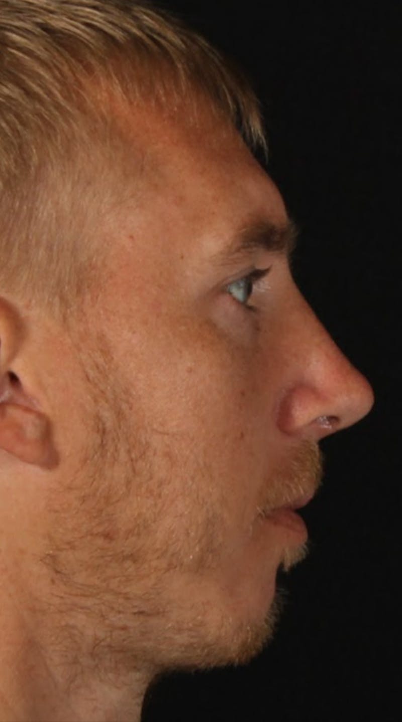 Rhinoplasty Male Before & After Gallery - Patient 418142 - Image 10